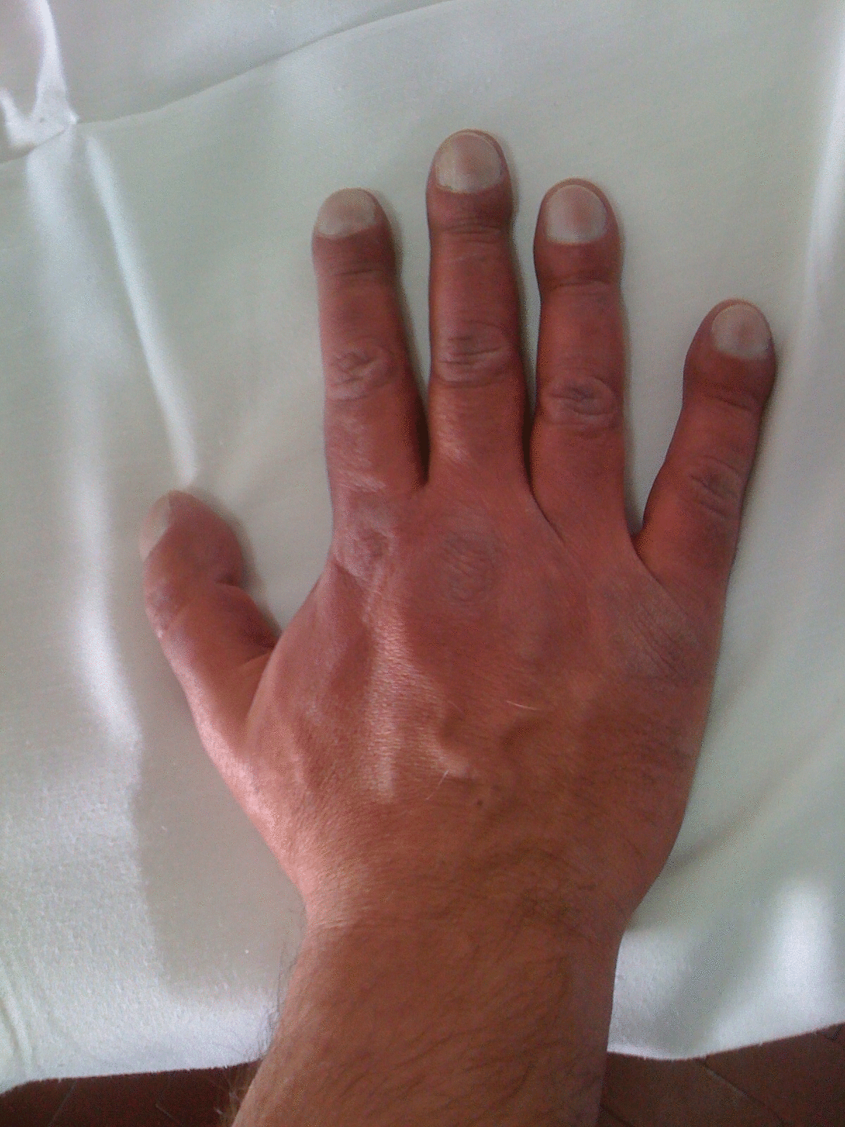 Aggregate 132+ cyanosis nails pictures super hot ceg.edu.vn