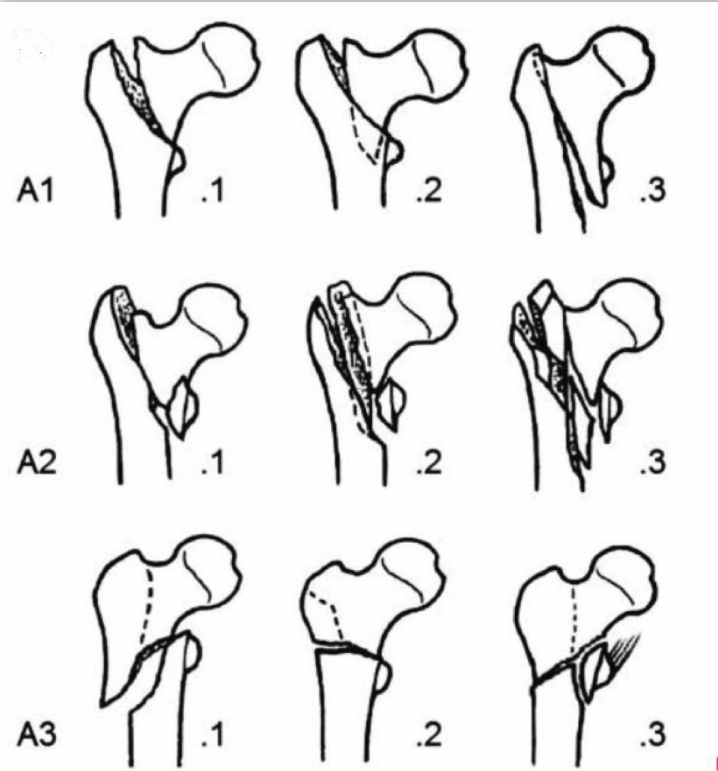 Классификация переломов шейки бедренной кости. Классификация переломов шейки бедренной кости. Переломы шейки бедренной кости классификация. Переломы шейки бедренной кости классификация. Переломы шейки бедренной кости классификация.